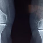 Comment devenir un chirurgien orthopédiste ?